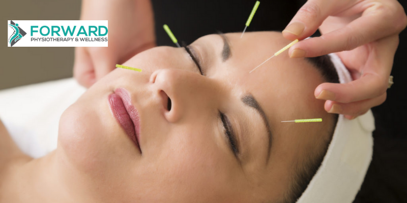 Relieve Your Stress with Acupuncture Treatment