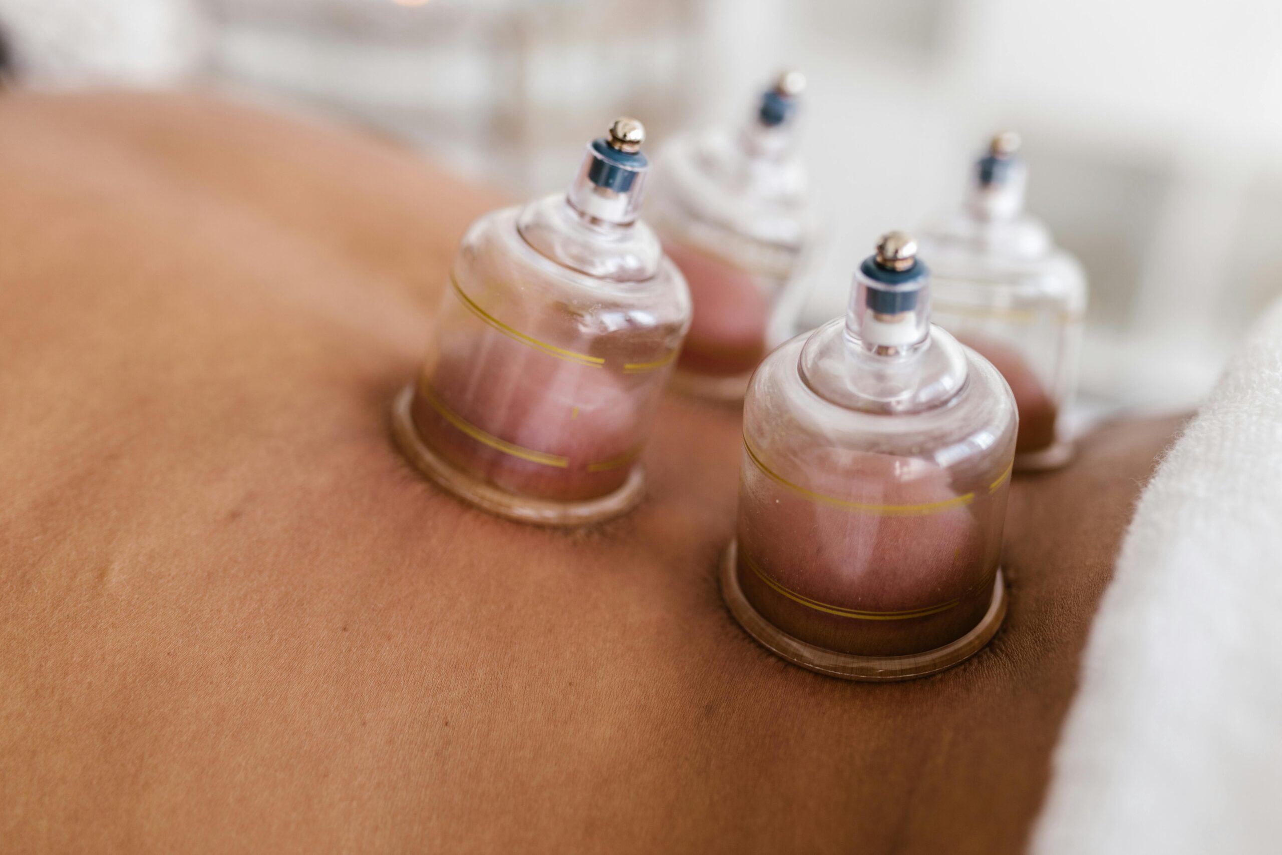 Cupping therapy session with glass cups applied to a client's back to relieve muscle tension and improve circulation